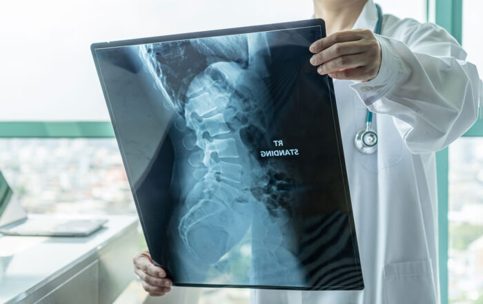 Personal Injury damages, doctor looking at an x-ray